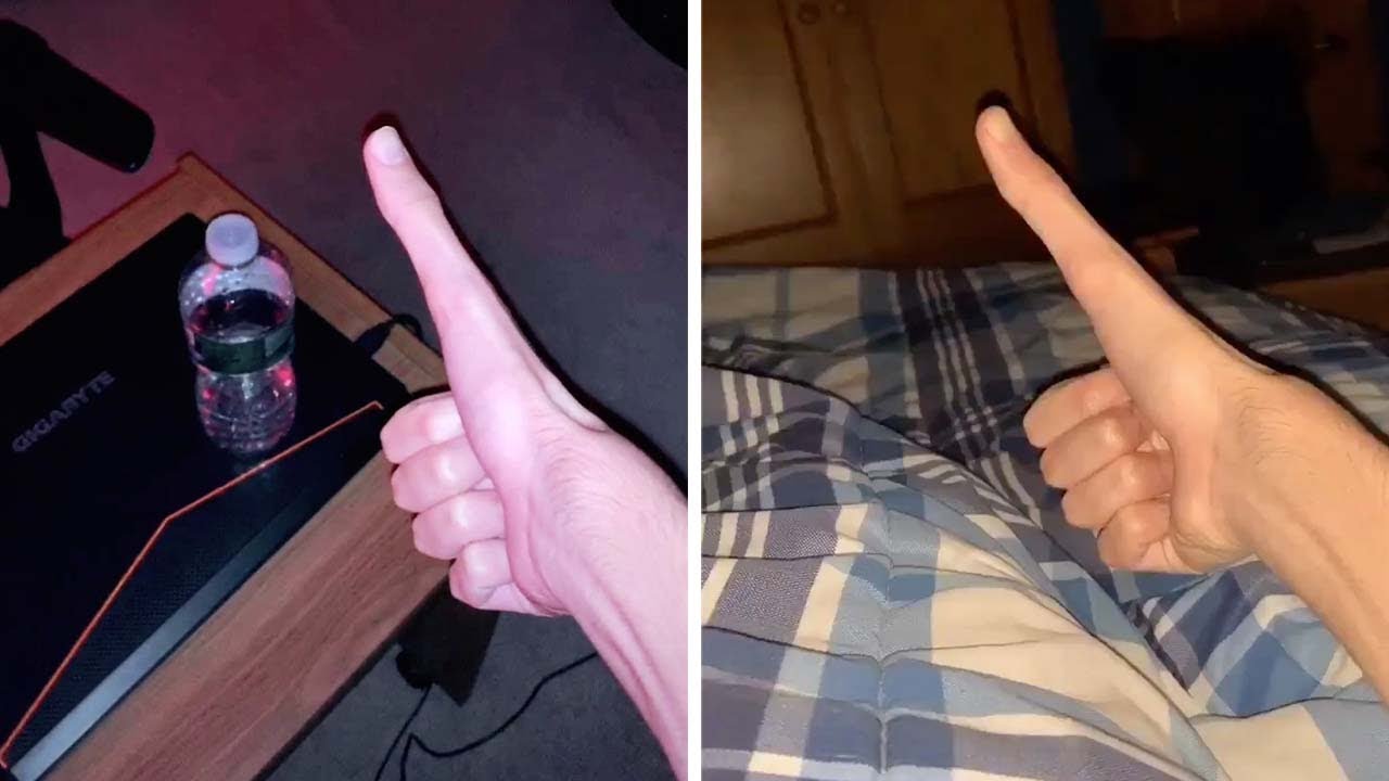 Teen Has Five Inch Long Thumb