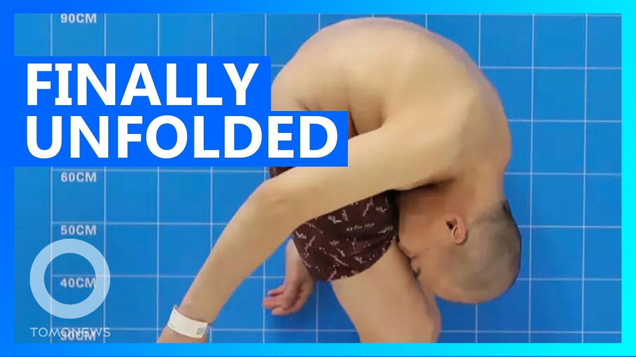 Man folded in half for 28 years finally stands straight - TomoNews