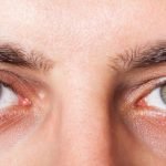 Imagem relacionada a Conjuntivite - Sintomas e Tratamentos