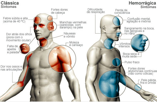 Imagem relacionada a Dengue - Sintomas e Tratamentos