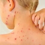 Imagem relacionada a Catapora - Sintomas e Tratamentos