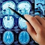 Imagem relacionada a Esclerose Múltipla - Sintomas e Tratamentos