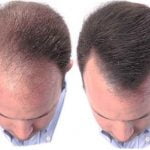 Imagem relacionada a Como funciona o Implante Capilar?