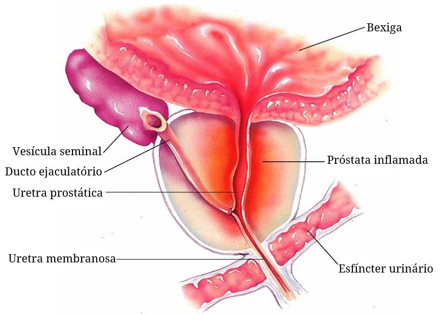 Imagem relacionada a Prostatite - Sintomas e Tratamentos