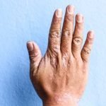 Imagem relacionada a Psoríase - Sintomas e Tratamentos