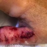 Imagem relacionada a Mulher quase perdeu a mão para bactérias que comem carne depois de fazer manicure