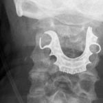 Imagem relacionada a Médicos encontram dentadura alojada na garganta do homem