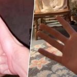 Imagem relacionada a Polegar insano de 12 cm de homem se torna viral