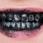 Imagem relacionada a Perigos do clareamento dos dentes com carvão ativado