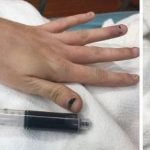 Imagem relacionada a Medicação faz com que o sangue da mulher fique azul