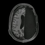 Imagem relacionada a Você consegue sobreviver com metade do seu cérebro removido?