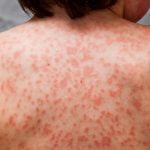 Imagem relacionada a O que é a Doença de Kawasaki?