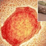 Imagem relacionada a Varíola dos Macacos: o que sabemos sobre os surtos?