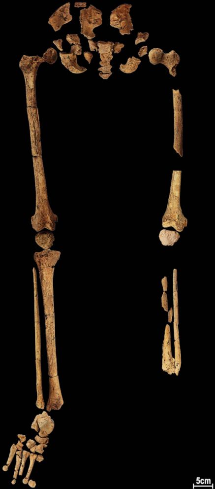 Imagem relacionada a Primeira amputação cirúrgica de membro ocorreu há 31.000 anos