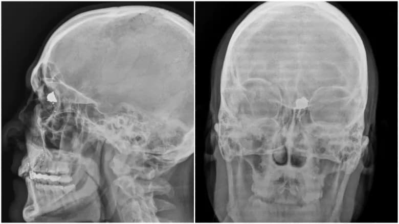 Imagem relacionada a Clint Malarchuk: o jogador da NFL que sofreu uma lesão esportiva horrível