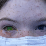 Imagem relacionada a Besouro suspeito de ser a causa de doença ocular debilitante na Austrália