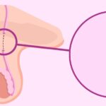 Imagem relacionada a O que é Vasectomia? Procedimento, riscos e reversão