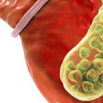 Imagem relacionada a Saiba qual é a função da vesícula biliar e as consequências da sua remoção